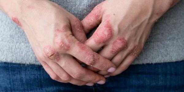 Persona que muestra sus manos, picor y heridas en la piel 