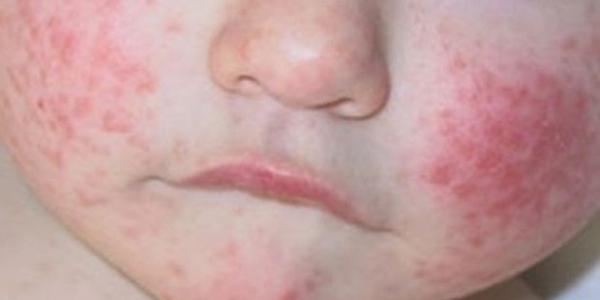 Dermatitis atópica en los mofletes de un bebé