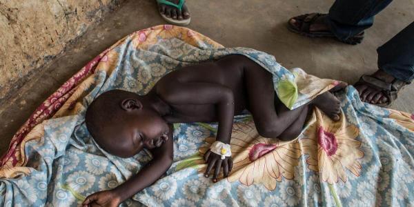 La desnutrición aguda severa y la hambruna aumenta en los países menos desarrollados