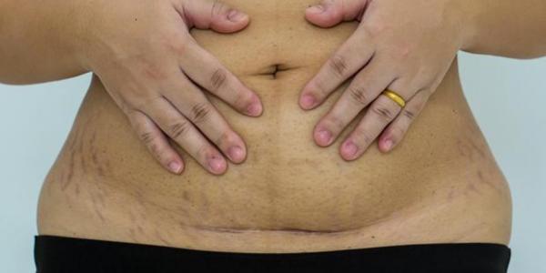La diástasis abdominal puede ocurrir durante y después del embarazo