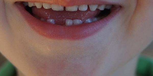 Los dientes de leche pueden ayudar a investigar las enfermedades raras