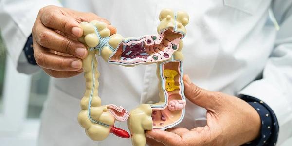 La diverticulosis si no se trata deriva en diverticulitis, más grave