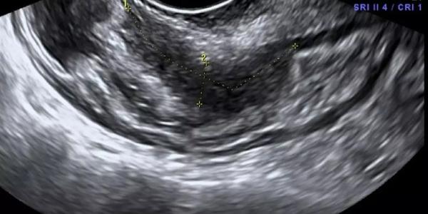 Endometrio tras una ecografía