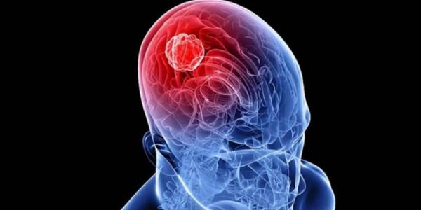 Infografía del cerebro de una persona con alguna enfermedad neuromuscular / Pixabay