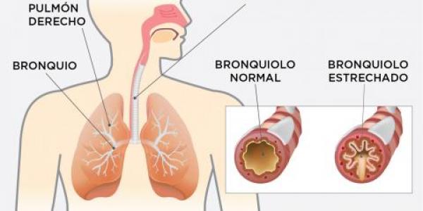 Ejemplo de pulmones con EPOC