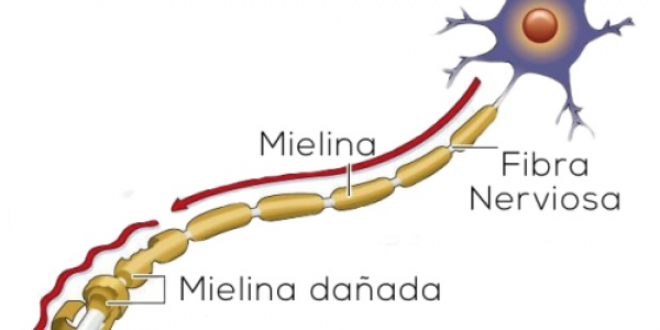 La enfermera Noelia Martín ha conseguido recaudar 15.000 euros para la investigación de la Esclerosis Múltiple