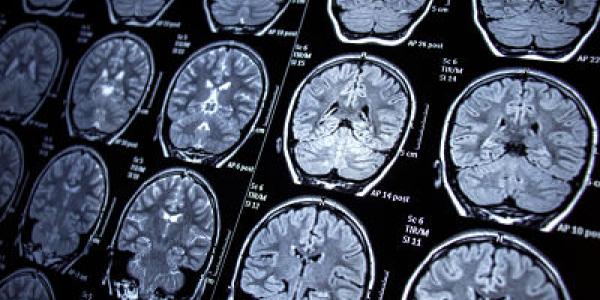 El Covid-19 causa lesiones en el cerebro