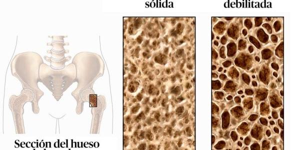 Ejemplo de huesos con y sin osteoporosis