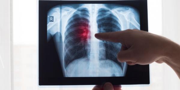 Radiografía de cáncer de pulmón