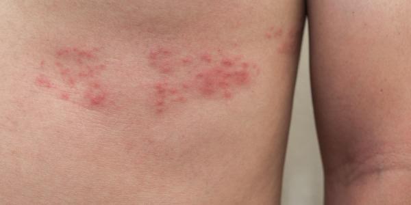 Herpes zóster, ¿de qué trata esta infección?
