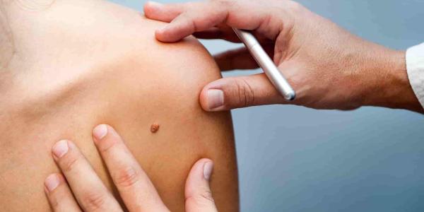Los expertos recomiendan cribados para detectar el melanoma