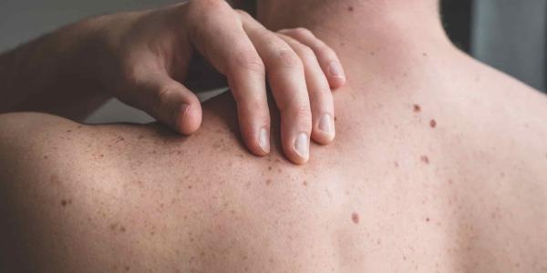 El melanoma destaca en las zonas con más dinero