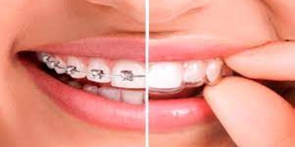 Brackets y alineadores invisibles/Dentaltix