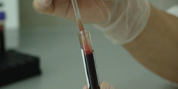 Análisis en el laboratorio del sangre de pacientes con sida