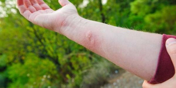 Picadura de avispa asiática