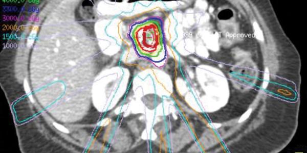 Destacan la efectividad de la radioterapia que cura entre el 40 y el 90% de los tumores de cabeza