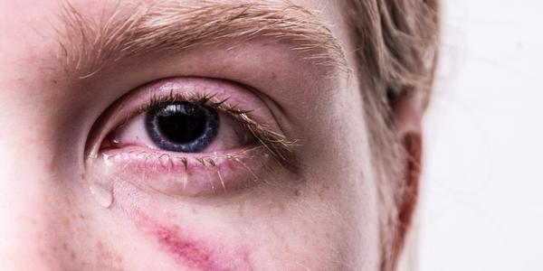 Adolescente llorando con una marca debajo del ojo por un golpe / Pixabay