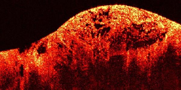 Sarcoma / Wikipedia Sarcoma