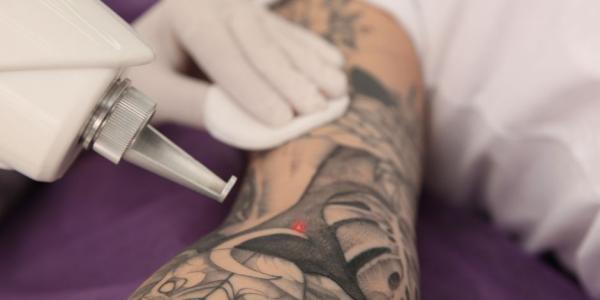Cada vez son más las personas que eliminan sus tatuajes