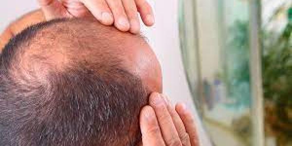 Alopecia/Noticias en salud