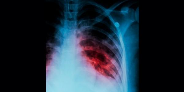 Aumentan las muertes de tuberculosis debido al Covid-19. Imagen: medlineplus.gov