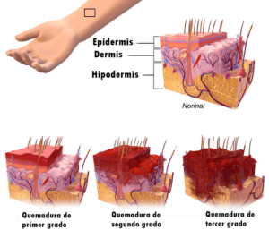 Tipos quemaduras